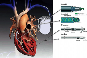 How a pacemaker works